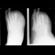 Osteomyelitis of metatarsal bones: X-ray - Plain radiograph